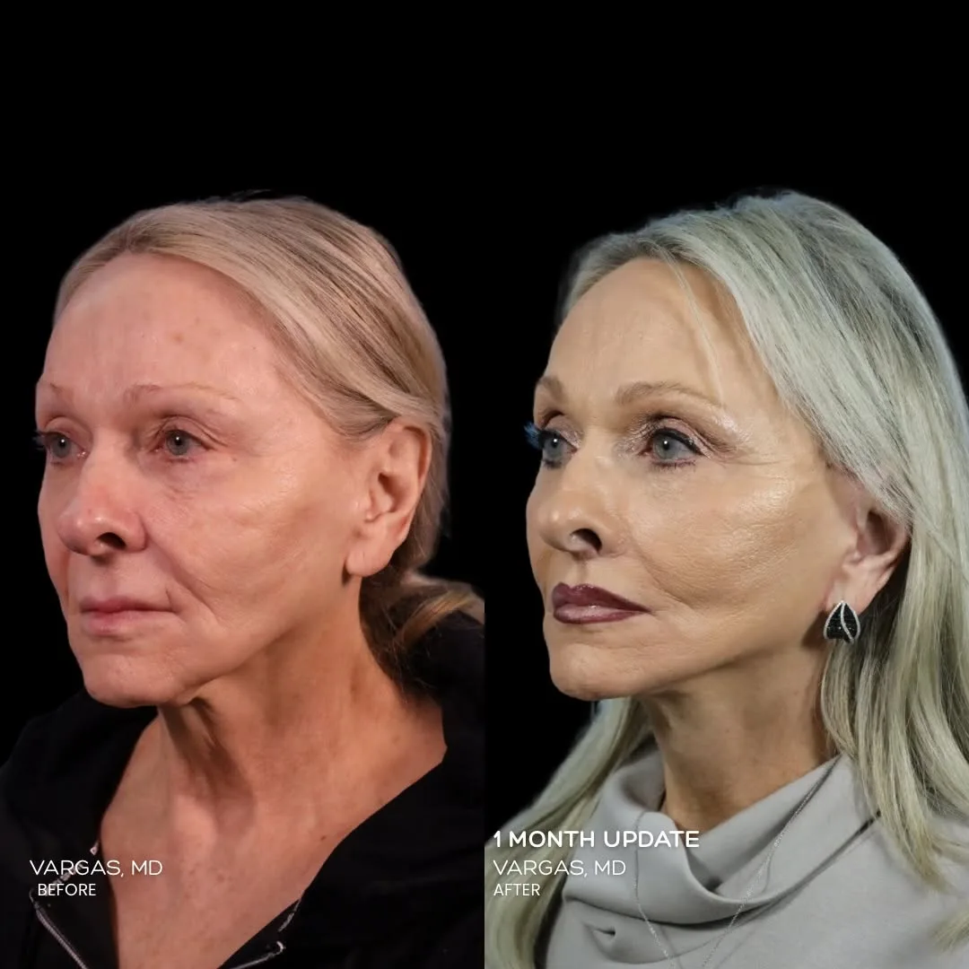 Before and after — Dr. Hannah Vargas