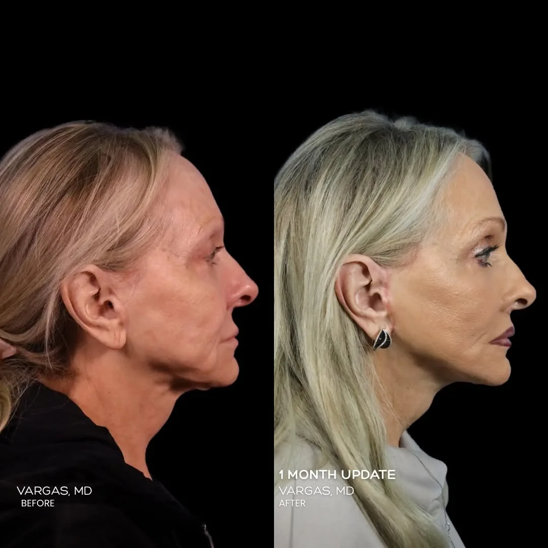 Before and after — Dr. Hannah Vargas