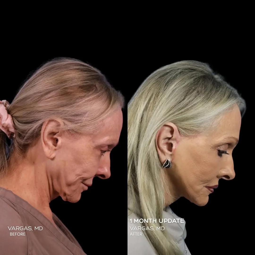 Before and after — Dr. Hannah Vargas