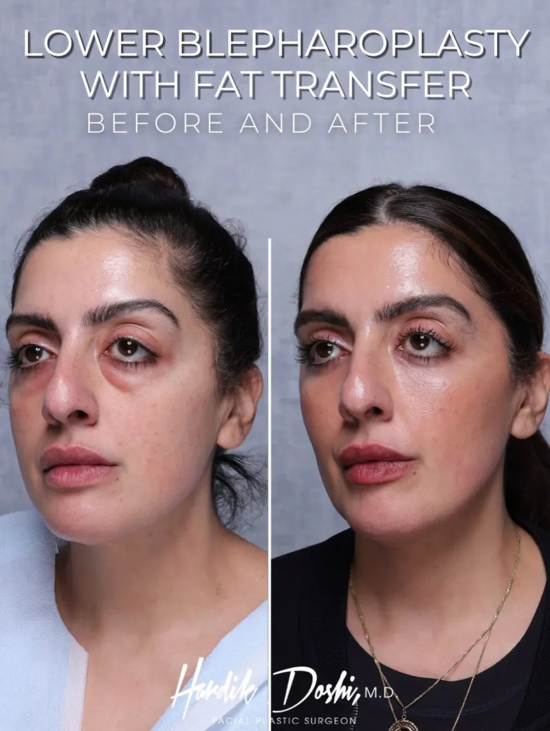Avant & Après - Deep Plane Facelift par Dr. Hardik Doshi