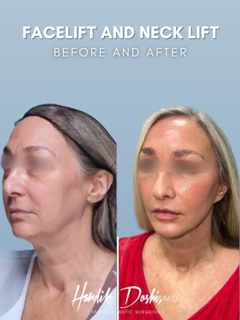 Avant & Après - Deep Plane Facelift par Dr. Hardik Doshi