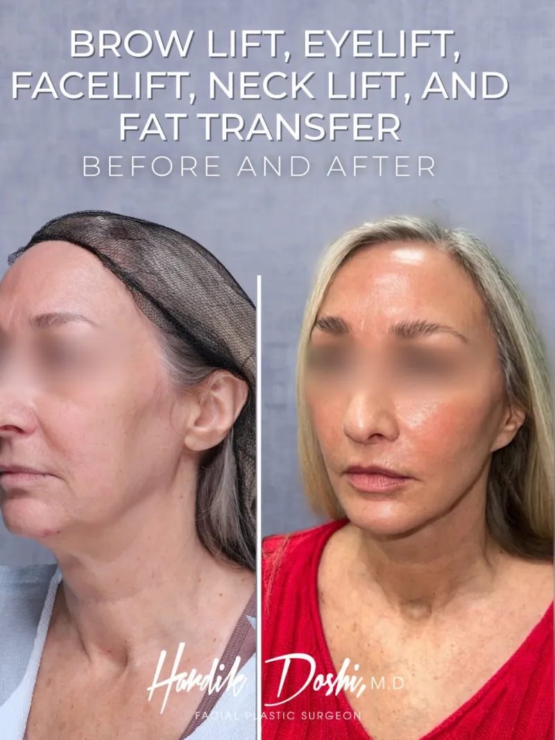 Avant & Après - Deep Plane Facelift par Dr. Hardik Doshi