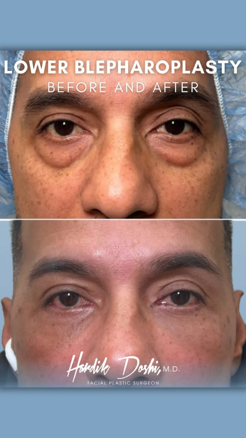 Avant & Après - Deep Plane Facelift par Dr. Hardik Doshi