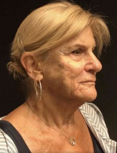Before and after — Dr. Harold Beam