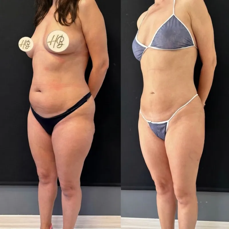 Before and after — Dr. Hasan Büyükdoğan