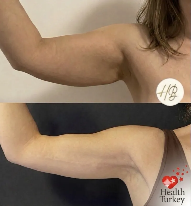 Before and after — Dr. Hasan Büyükdoğan
