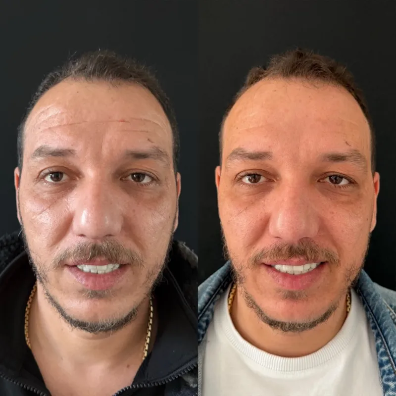 Before and after — Dr. Hasan Büyükdoğan