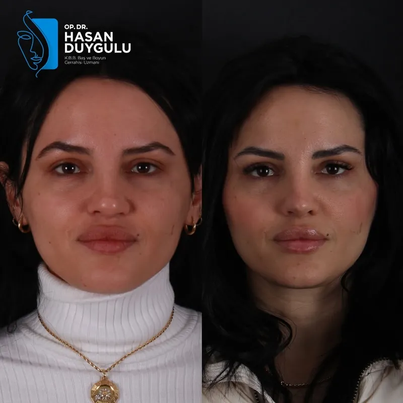 Before and after deep plane facelift, frontal view by Dr. Hasan Duygulu