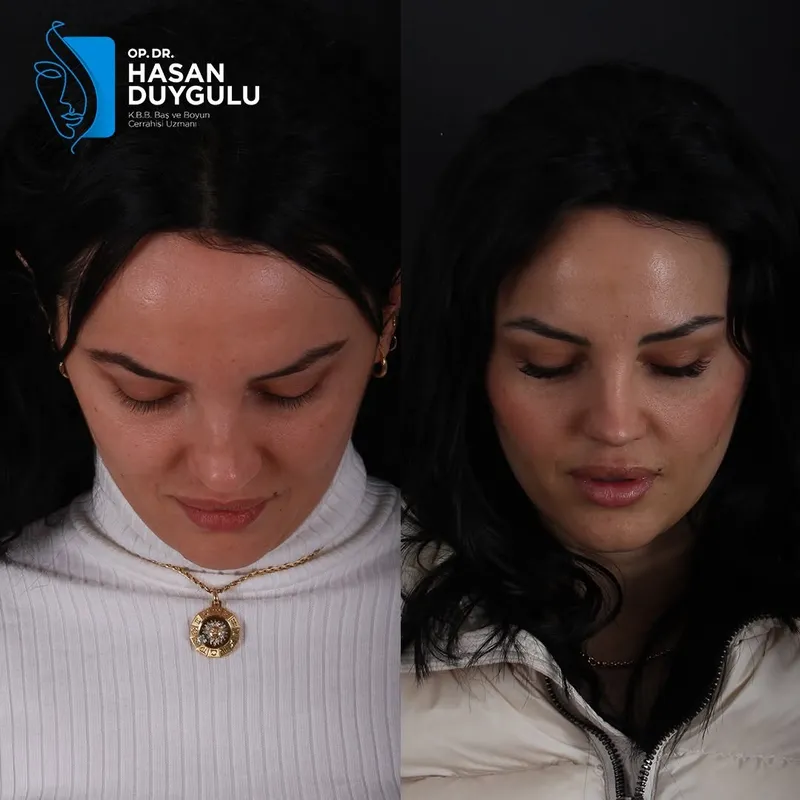 Before and after deep plane facelift, frontal view by Dr. Hasan Duygulu