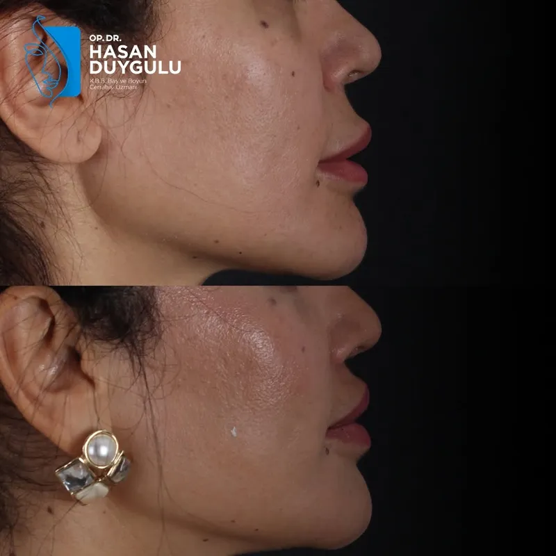 Before and after deep plane facelift, frontal view by Dr. Hasan Duygulu