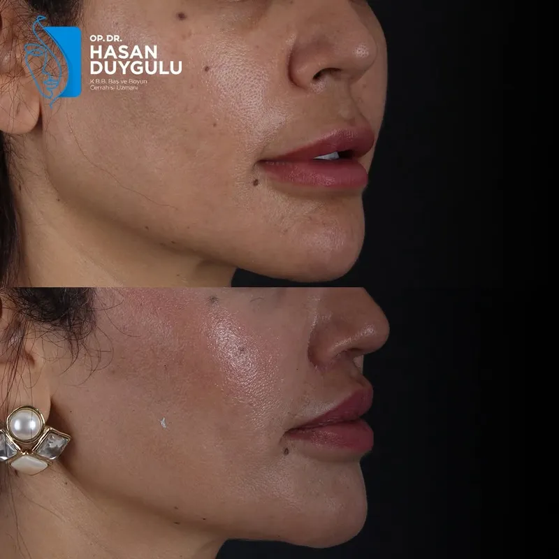 Before and after deep plane facelift, frontal view by Dr. Hasan Duygulu