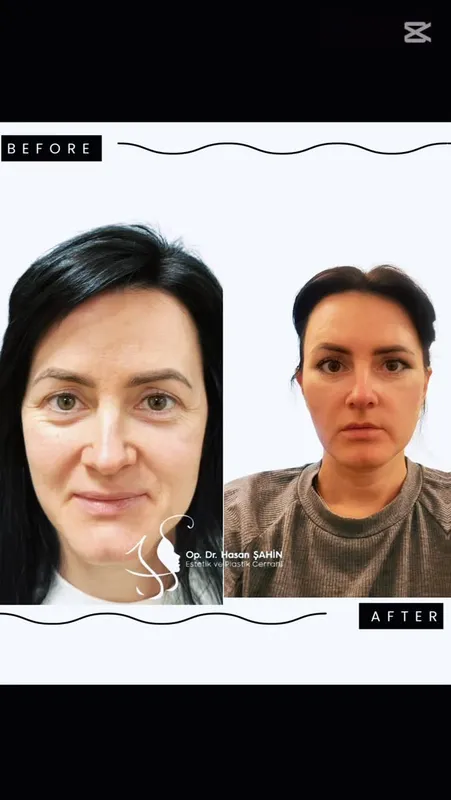 Before and after — Dr. Hasan Şahin