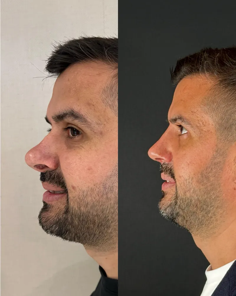 Before and after — Dr. Hayati Kale