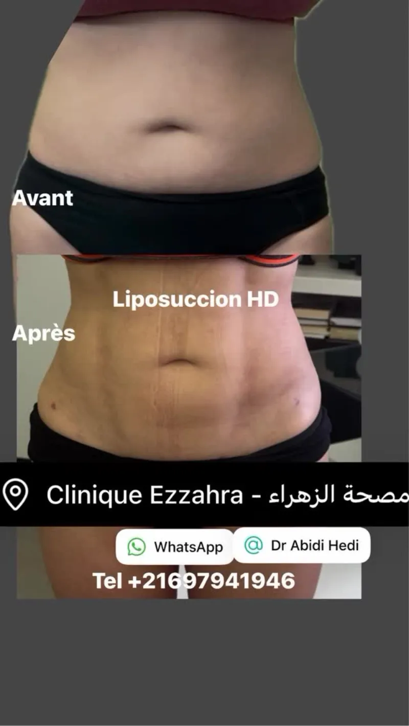 Before and after — Dr. Hedi Abidi