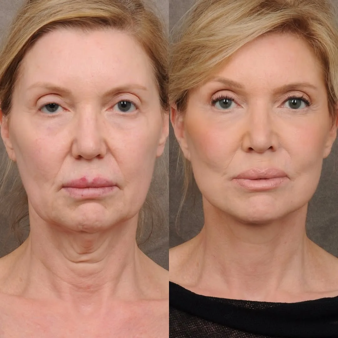 Before and after — Dr. Hedyeh Ziai