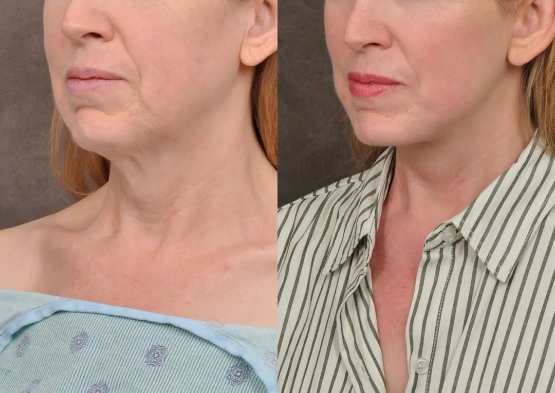 Before and after — Dr. Hedyeh Ziai