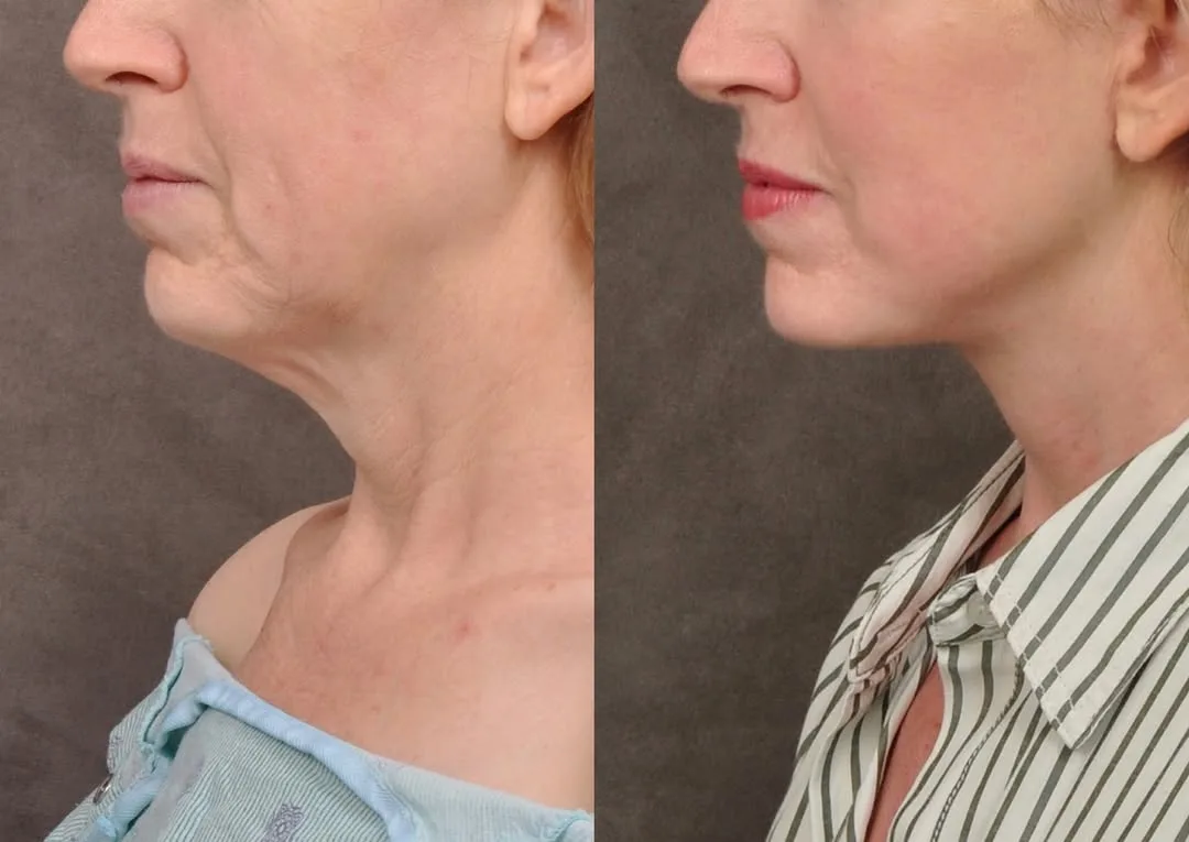 Before and after — Dr. Hedyeh Ziai
