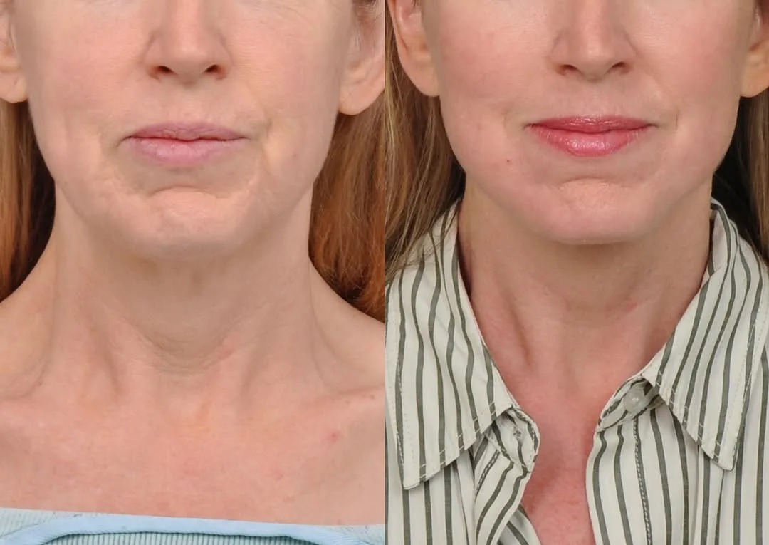 Before and after — Dr. Hedyeh Ziai