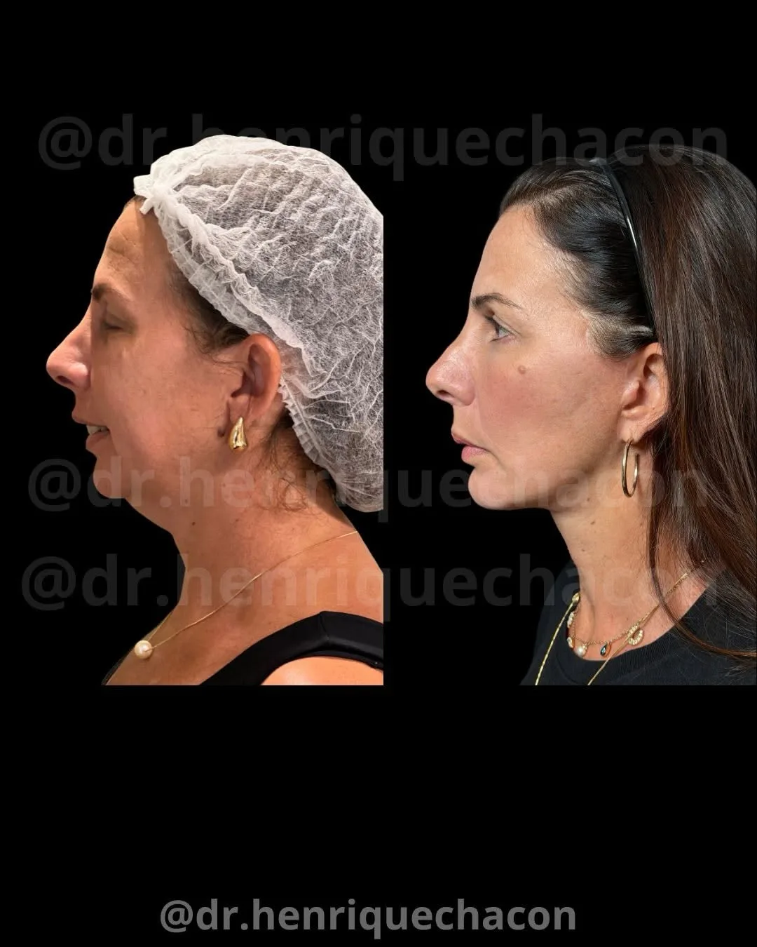 Before and after deep plane facelift — 48-year-old woman, right profile view, 6mo post-op by Dr. Henrique Chacon