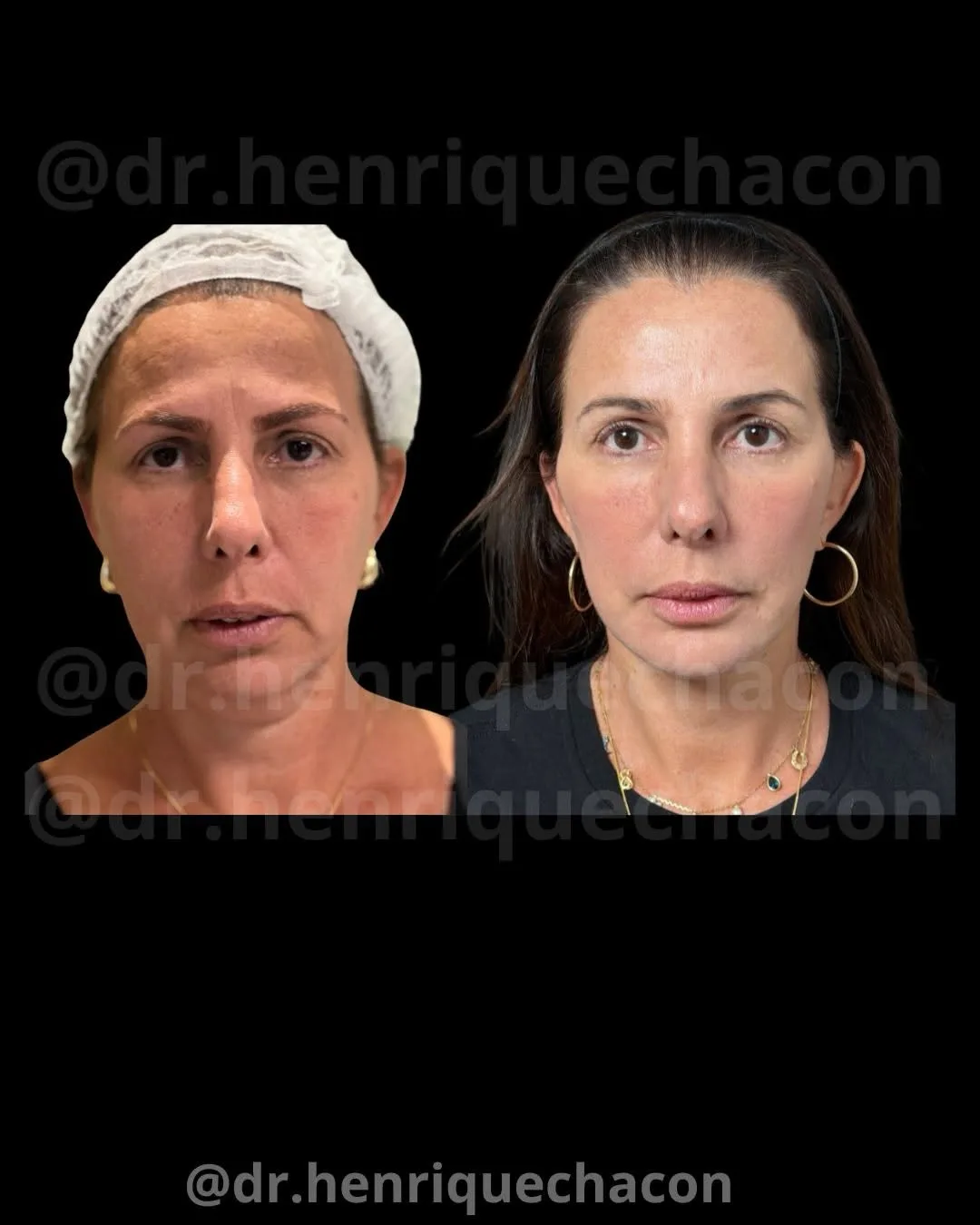 Before and after deep plane facelift — 48-year-old woman, frontal view, 6mo post-op by Dr. Henrique Chacon
