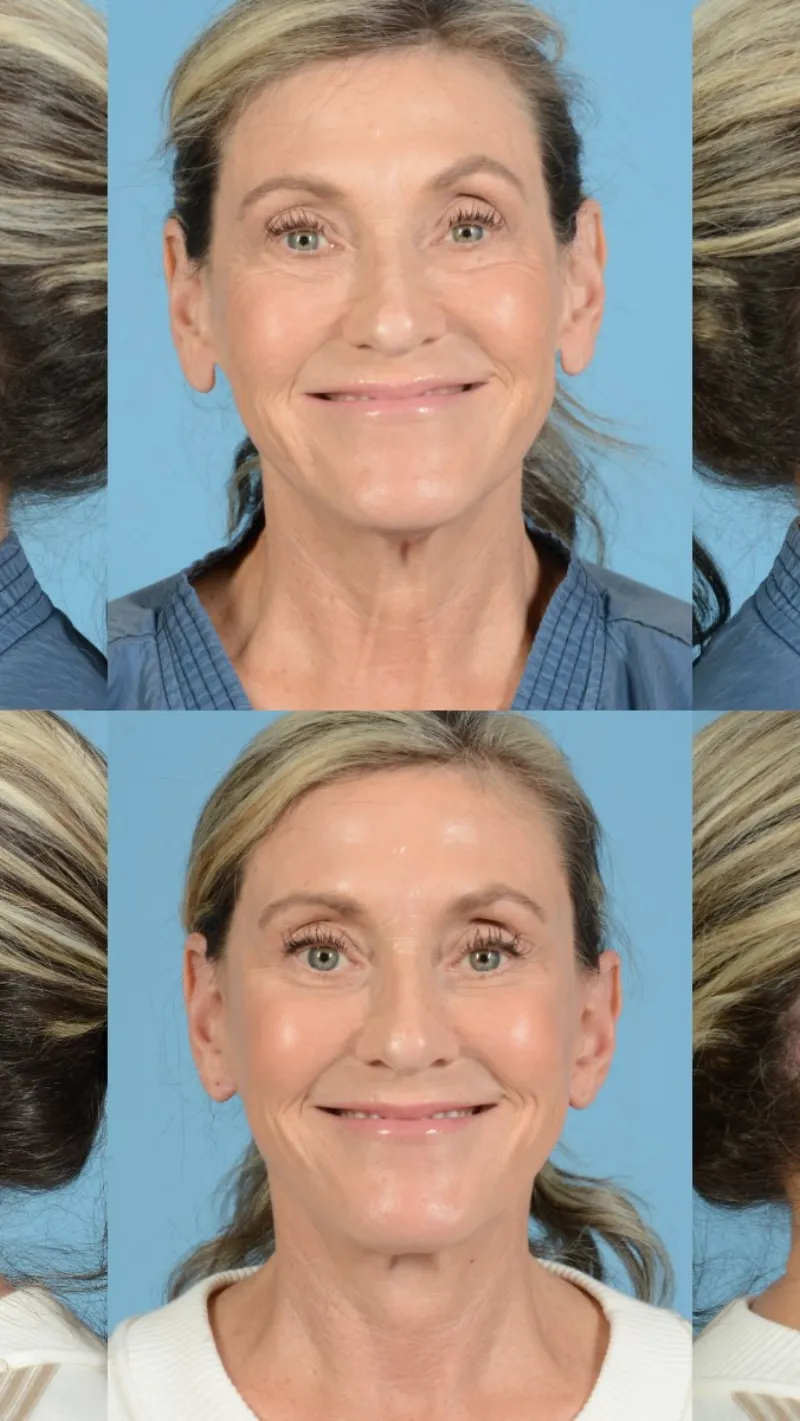 Before and after — Dr. Henry Mentz