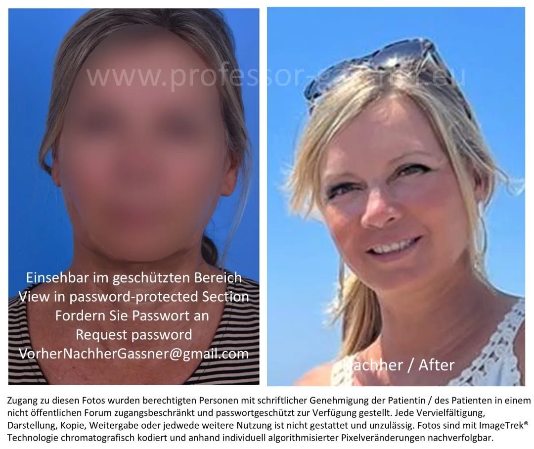 Before & After - Deep Plane Facelift by Dr. Holger Gassner