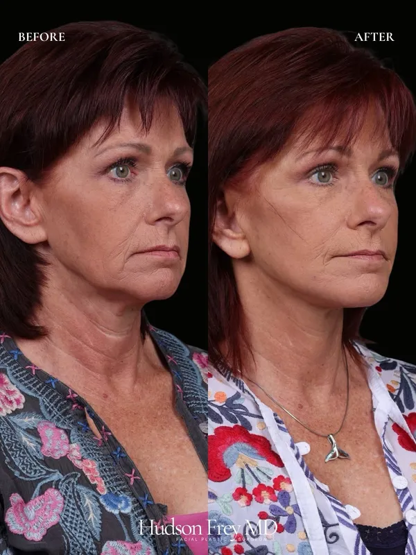 Before and after — Dr. Hudson Frey