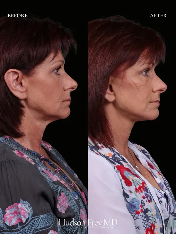 Before and after — Dr. Hudson Frey
