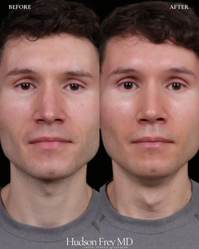 Before and after — Dr. Hudson Frey