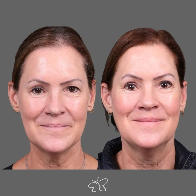 Before and after — Dr. Hudson Frey