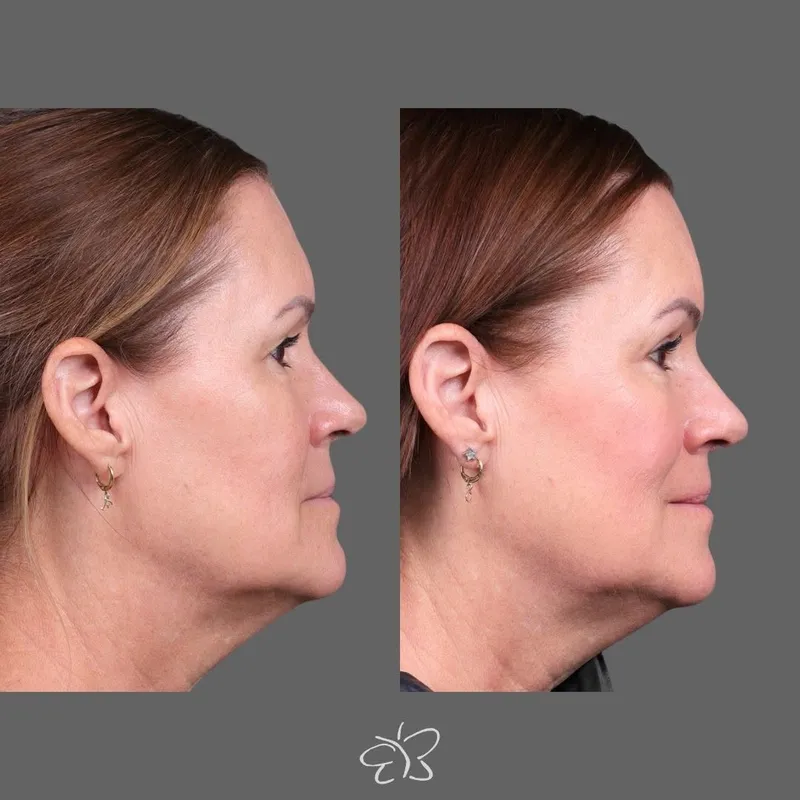 Before and after — Dr. Hudson Frey