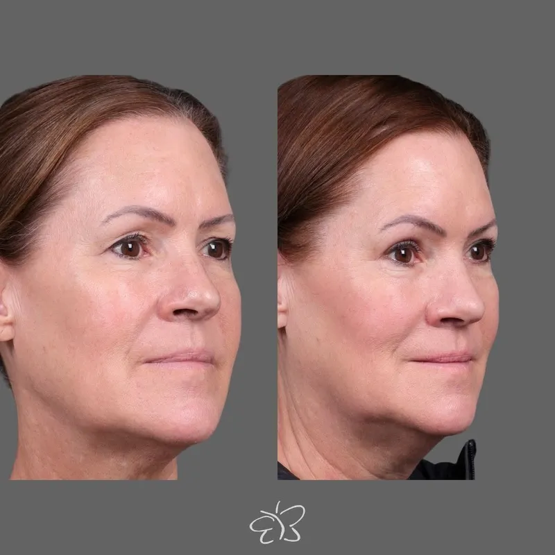 Before and after — Dr. Hudson Frey