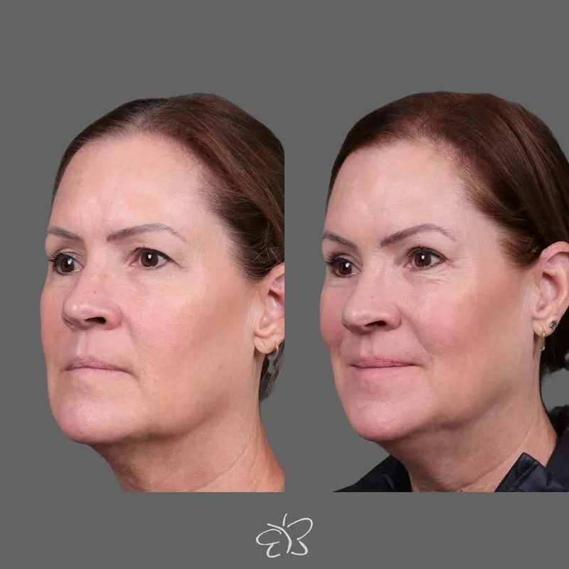 Before and after — Dr. Hudson Frey