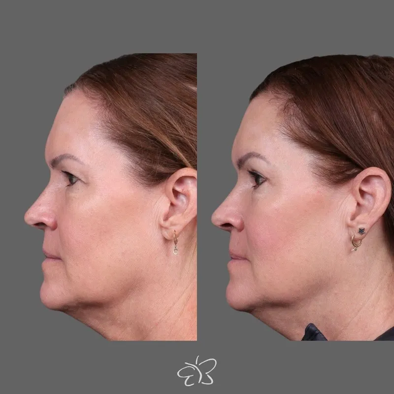 Before and after — Dr. Hudson Frey