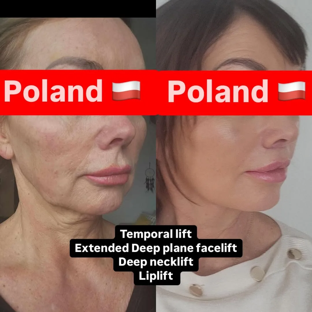 Before and after deep plane facelift — 58-year-old woman, left profile view, 6mo post-op by Dr. İbrahim Kavuğudurmaz