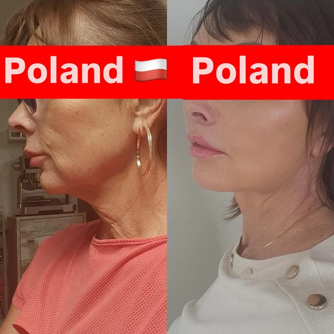 Before and after deep plane facelift — 55-year-old woman, left profile view, 6mo post-op by Dr. İbrahim Kavuğudurmaz