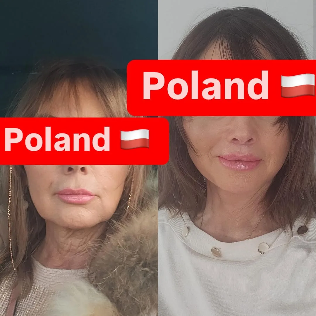 Before and after deep plane facelift — 55-year-old woman, oblique right view, 6mo post-op by Dr. İbrahim Kavuğudurmaz