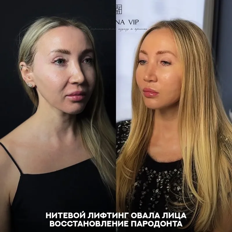Before and after deep plane facelift, frontal view by Dr. Ilona Totikova
