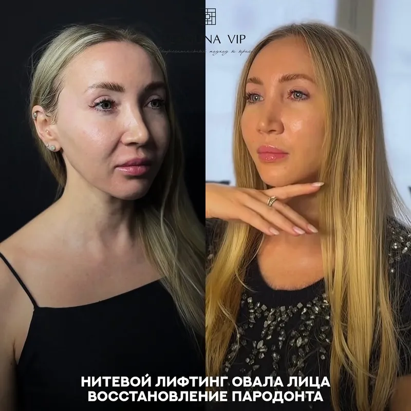 Before and after deep plane facelift, frontal view by Dr. Ilona Totikova