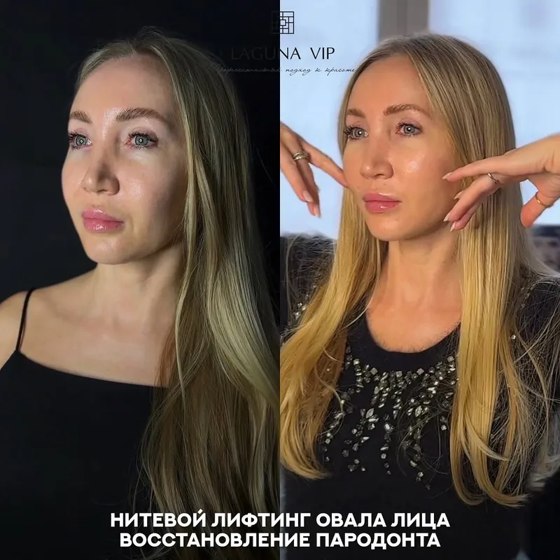Before and after deep plane facelift, frontal view by Dr. Ilona Totikova