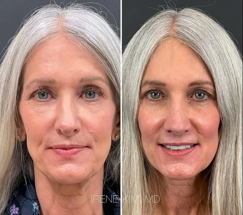 Before and after — Dr. Irene A. Kim