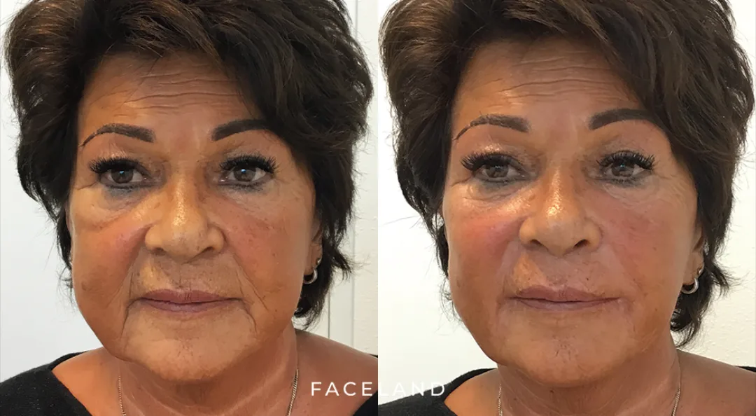 Before and after: Dr. Isabelle Francisca Petronella Maria Kappen
