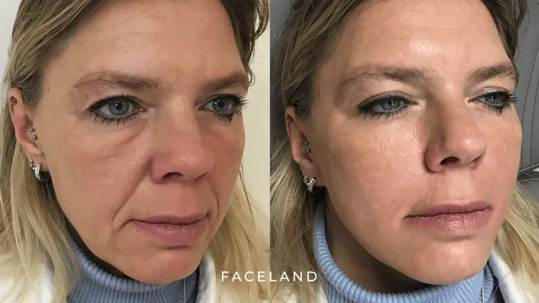 Before and after: Dr. Isabelle Francisca Petronella Maria Kappen