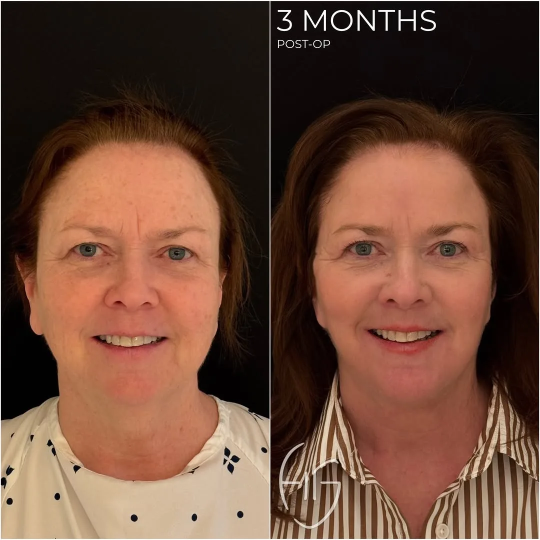 Before and after, Deep Plane Facelift