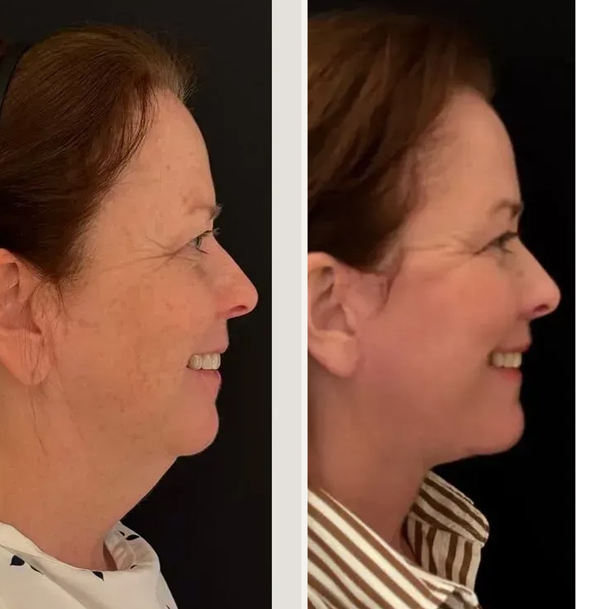 Before and after, Deep Plane Facelift