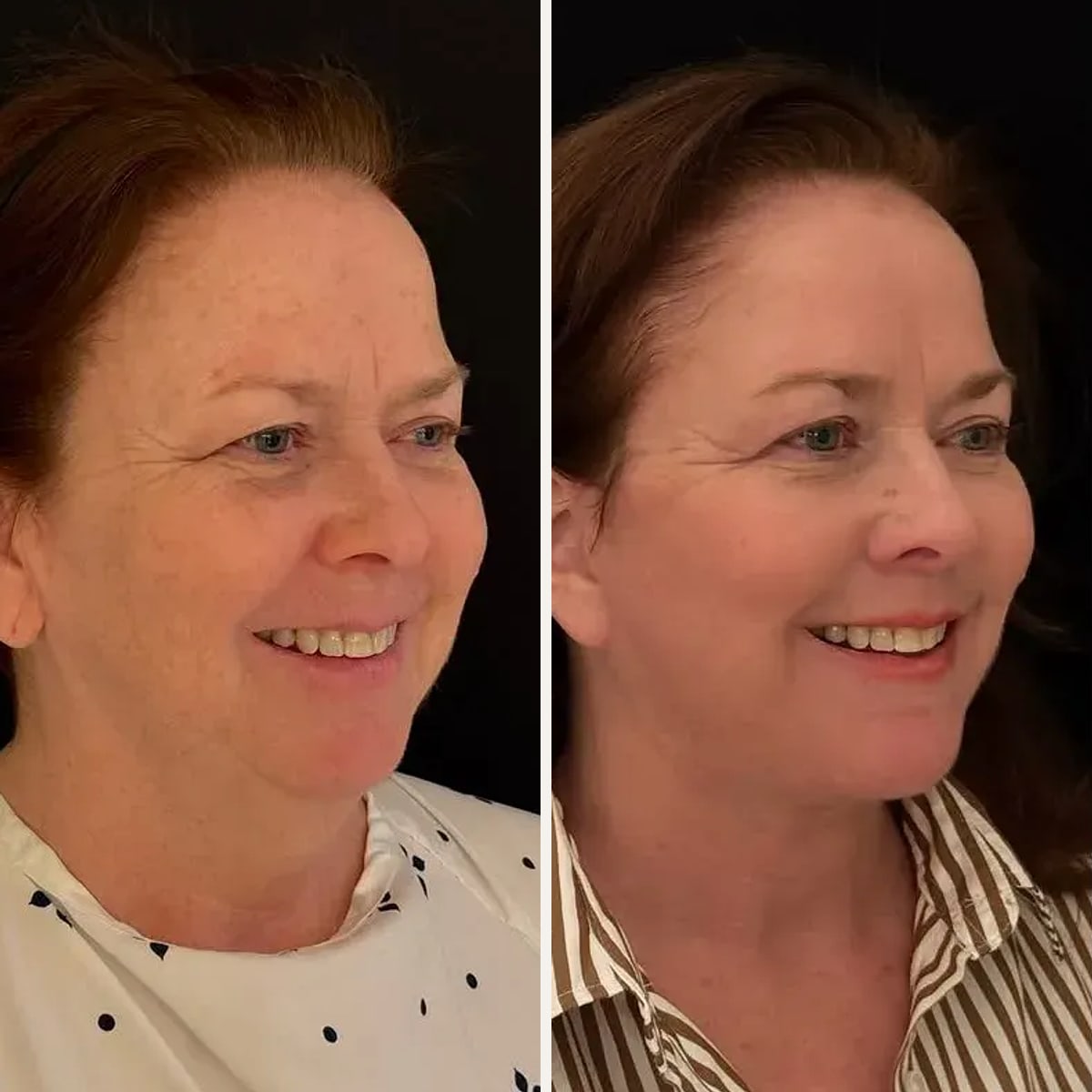 Before and after, Deep Plane Facelift