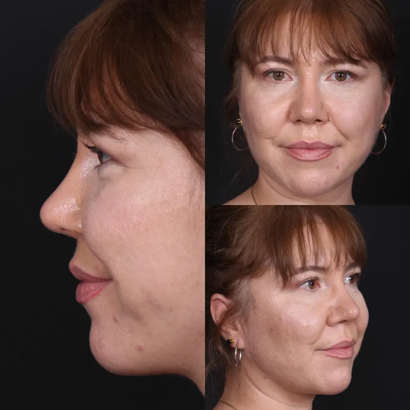Before and after — Dr. İsmail Küçüker