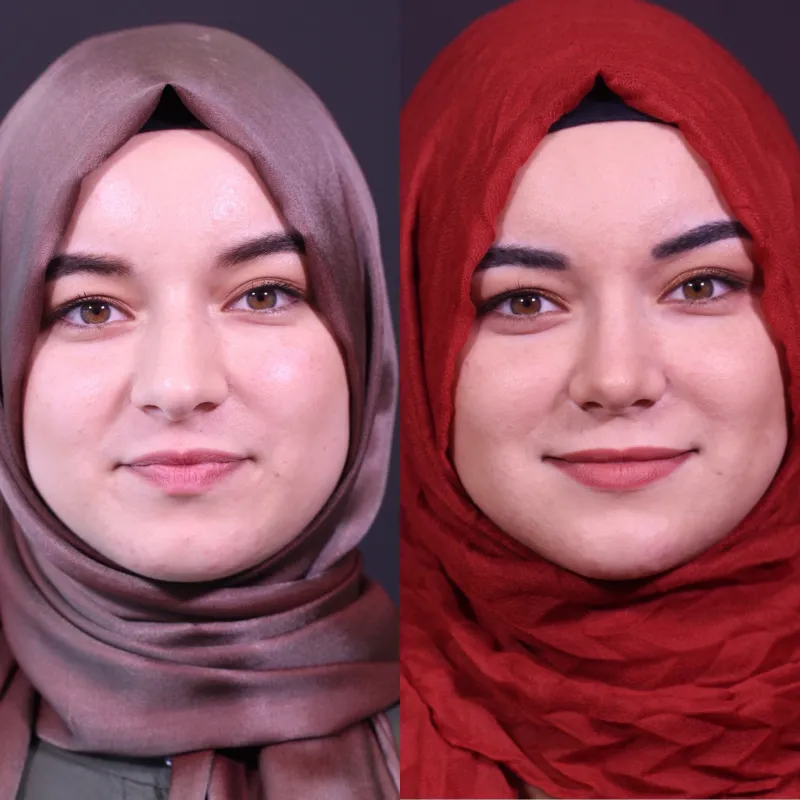 Before and after — Dr. İsmail Küçüker