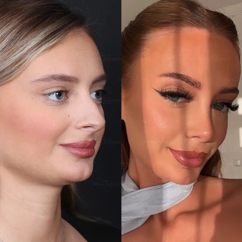 Before and after — Dr. İsmail Küçüker