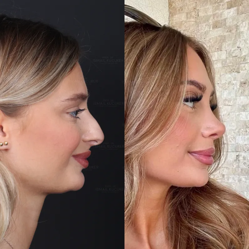 Before and after — Dr. İsmail Küçüker
